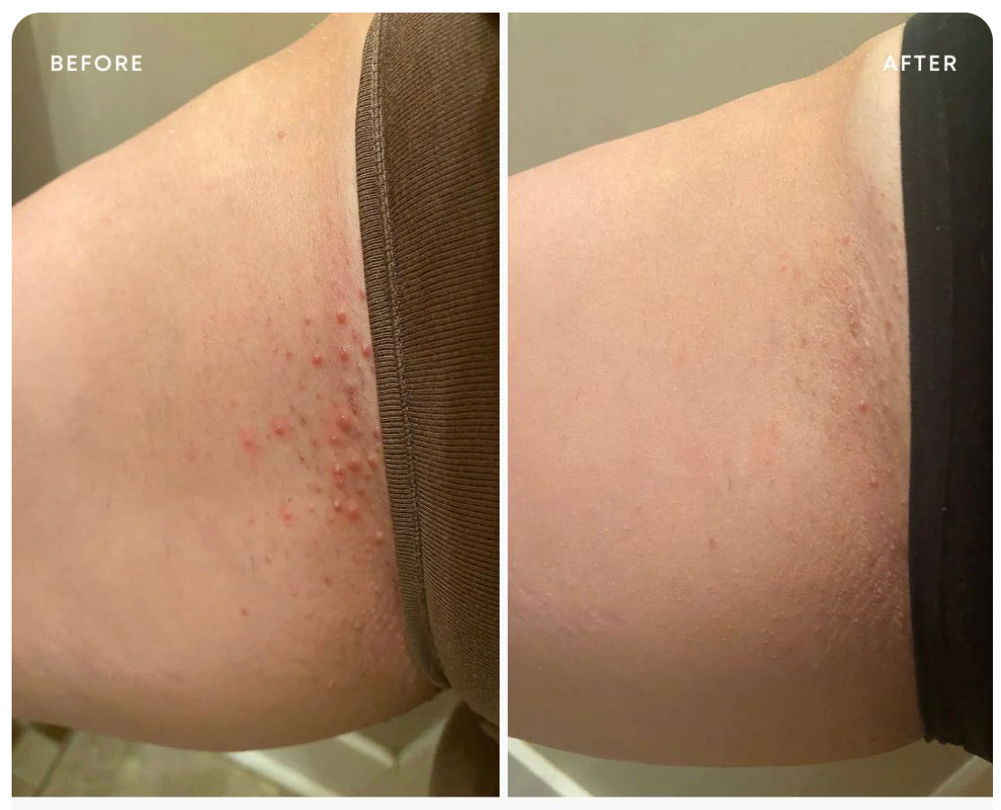 Ingrown Hair Oil
soothe + soften